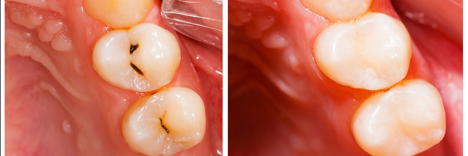 Seals Family Dentistry | Oral Cancer Screening, Inlays  amp  Onlays and Dental Sealants