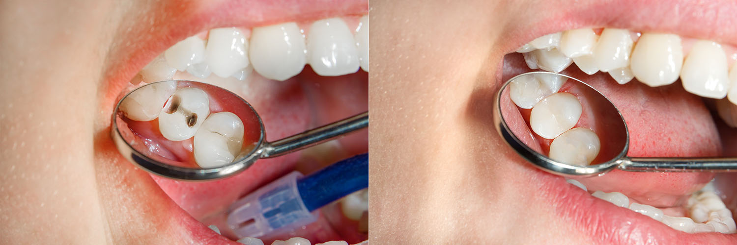 Seals Family Dentistry | Dental Bridges, Ceramic Crowns and Dental Fillings